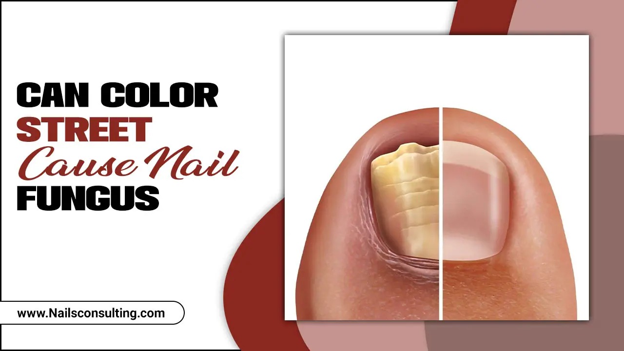 Can Color Street Cause Nail Fungus