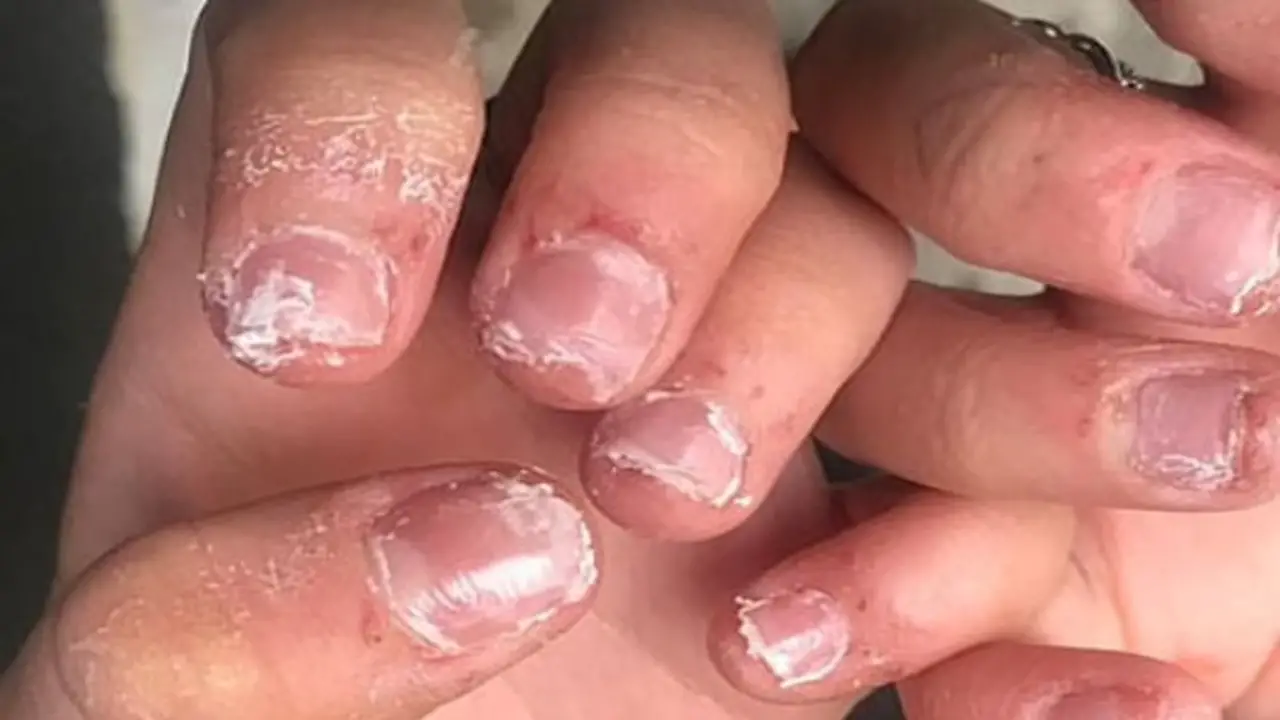 Can You Be Allergic To Polygel Nails Explained