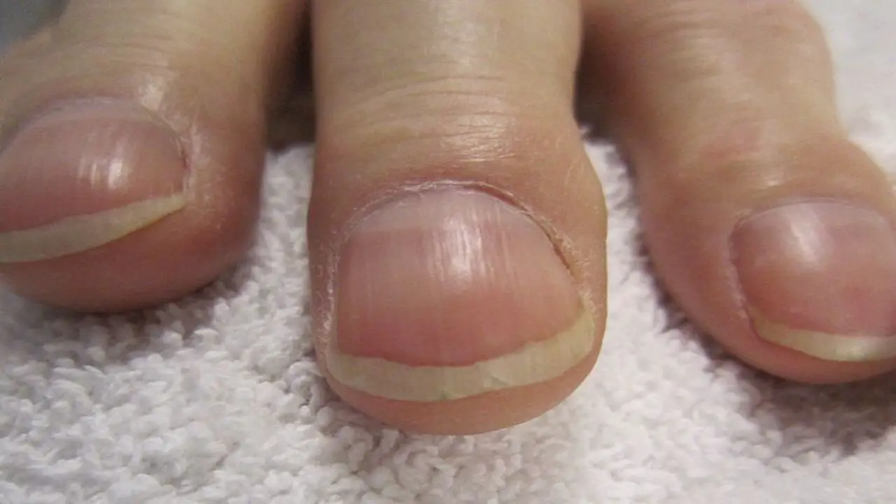 Nail Condition