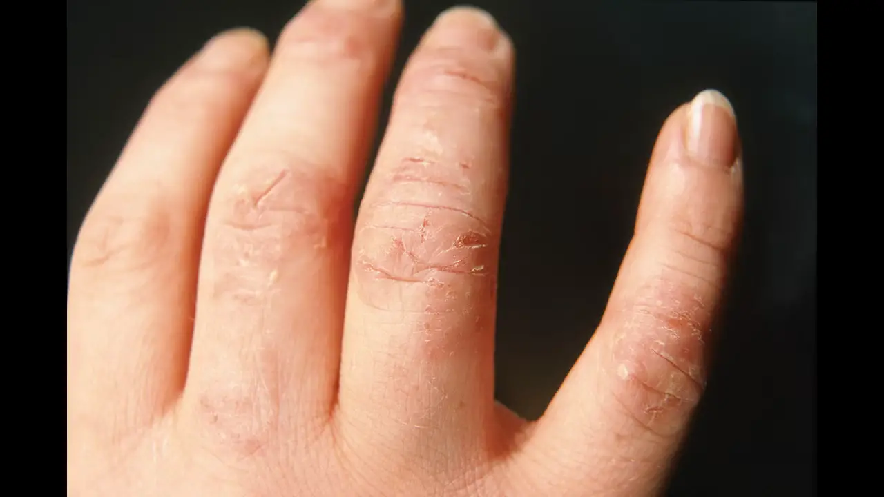 Tips For Maintaining Healthy Nails After An Allergic Reaction